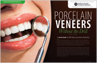 prepless-porcelain-veneers